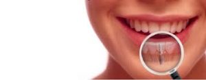 clinica dental implantes en Alicante